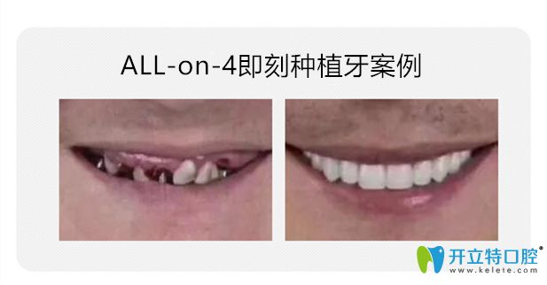 All-on-4即刻種植牙對(duì)比圖片