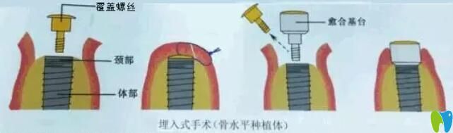 埋入式種植