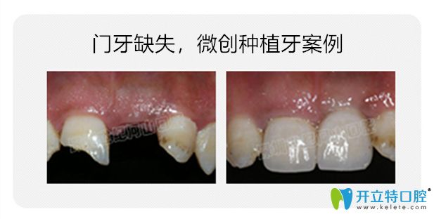 河山口腔微創(chuàng)種植牙案例對(duì)比圖