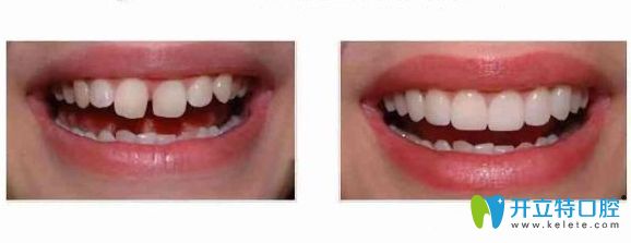 牙縫大做完牙齒矯正前后對比圖