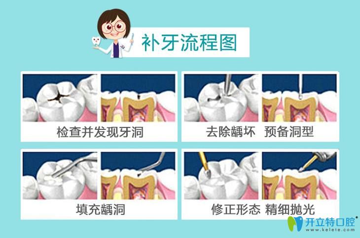 補牙流程圖示