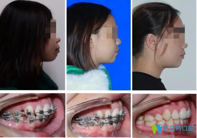惠州致美口腔牙齒矯正前后對(duì)比