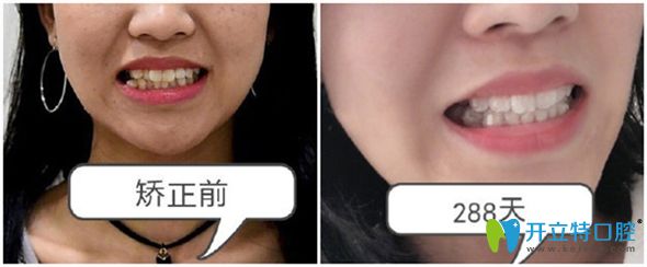 武漢仁愛口腔武漢仁愛口腔科正畸怎么樣?通過牙齒矯正案例效果來了解吧