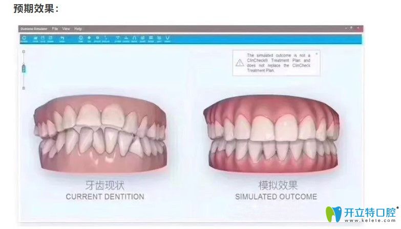 itero口內(nèi)可讓顧客提前預(yù)知矯正效果