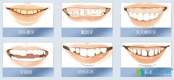 烤瓷牙適用人群