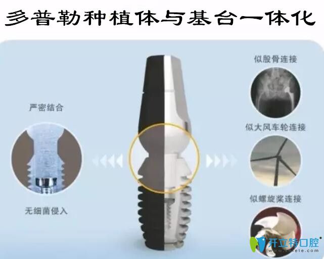 韓國多普勒種植牙優(yōu)勢(shì)
