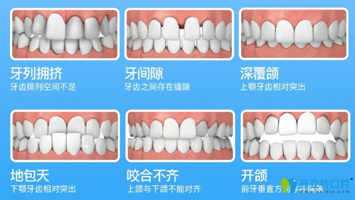 隱形牙套和鋼絲牙套哪個矯正效果好