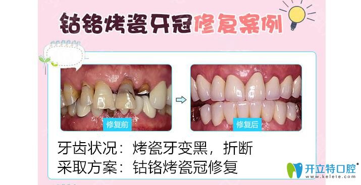 鈷鉻烤瓷牙修復(fù)案例
