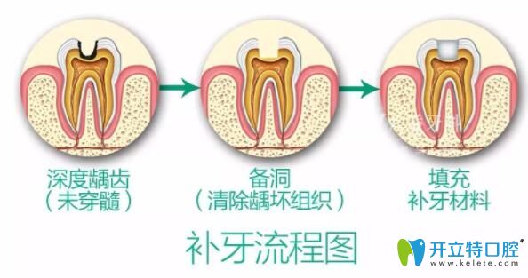補(bǔ)牙過程