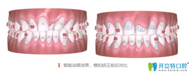 仁愛口腔有iTreo口掃儀