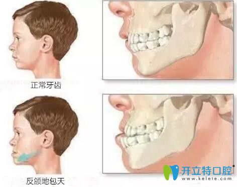 科普:兒童牙齒反頜矯正的年齡及步驟,內(nèi)附反頜牙套費(fèi)用