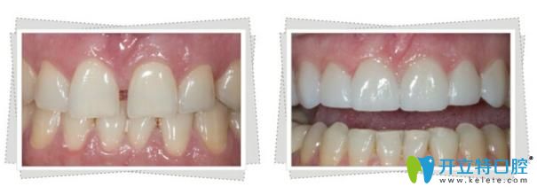 牙齒貼面前后對(duì)比圖