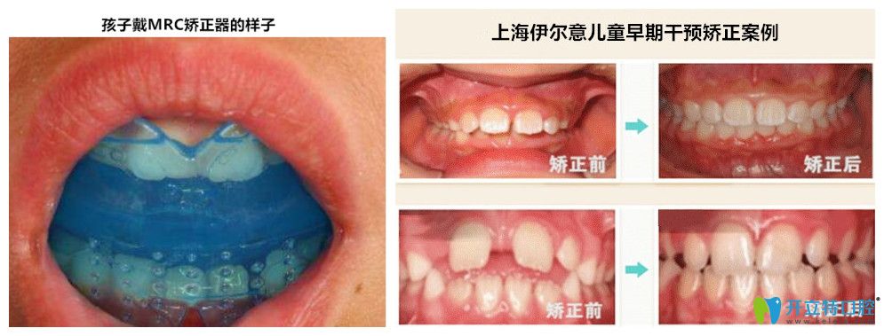 孩子戴MRC的樣子以及伊爾意孩子矯正的前后對(duì)比照
