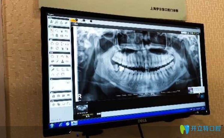 在<!--<i data=20240703-sp></i>-->伊爾意檢查牙齒時(shí)候拍的牙片