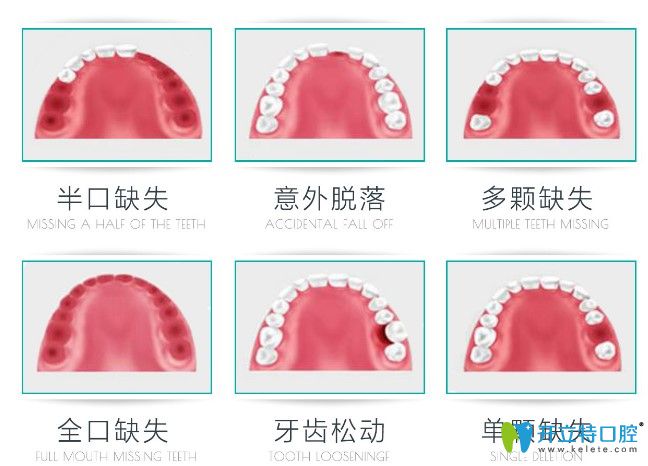 福州哪個(gè)醫(yī)院種植牙比較好