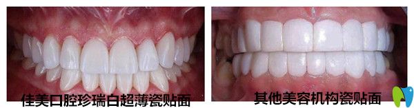 珍瑞白瓷貼面與其他機(jī)構(gòu)瓷貼面對比