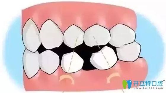 劉家威醫(yī)生談牙齒缺失不及時修復(fù)的危害