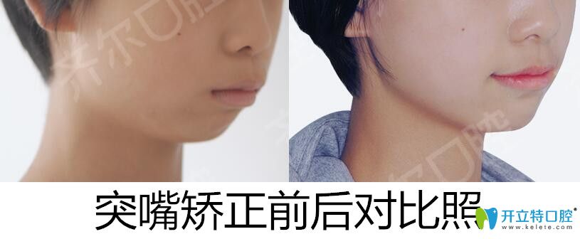 杭州齊爾口腔齙牙矯正前后對比照