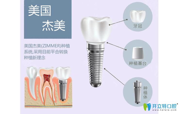 美國杰美種植體怎么樣以及zimmer種植牙價格，讓你5分鐘悉知