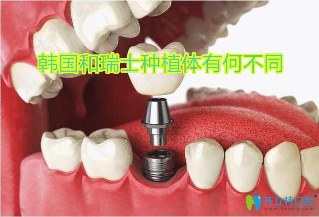 韓國和瑞士種植體有何不同,想要種牙更快一些看看它們區(qū)別