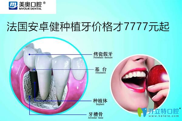 忒狠！聽說上海美奧口腔法國安卓健種植牙價格7777元起