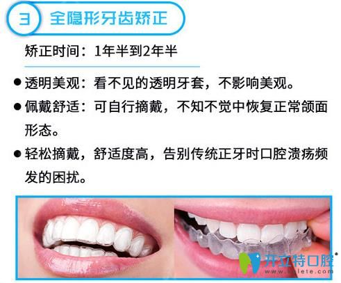 全隱形矯正