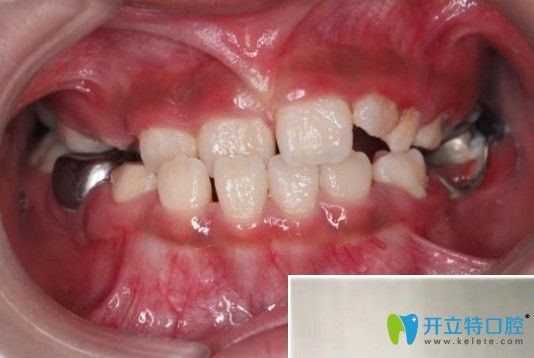 孩子地包天在凸牙醫(yī)做矯正前的牙齒圖