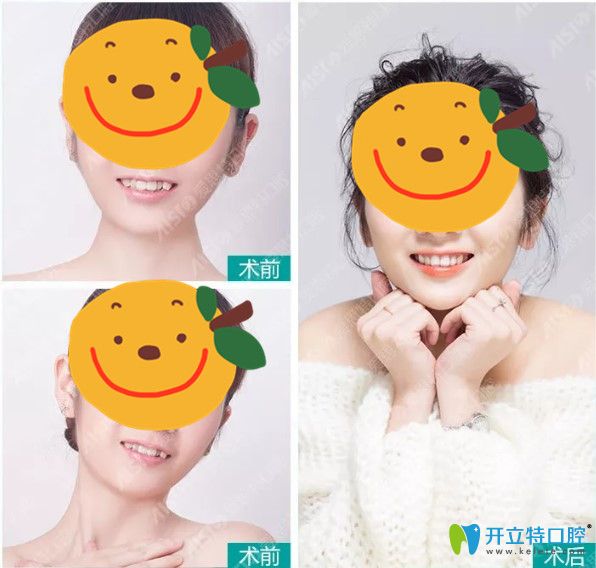 矯正后美美噠的效果圖也是愛思特口腔實力的佐證