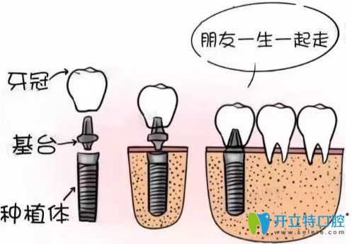 種植牙閃亮登場(chǎng)