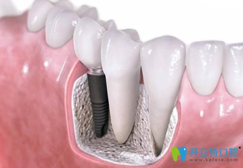 深圳格倫菲爾韓國系統(tǒng)種植牙