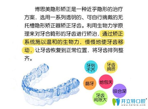博思美隱形矯正介紹圖示