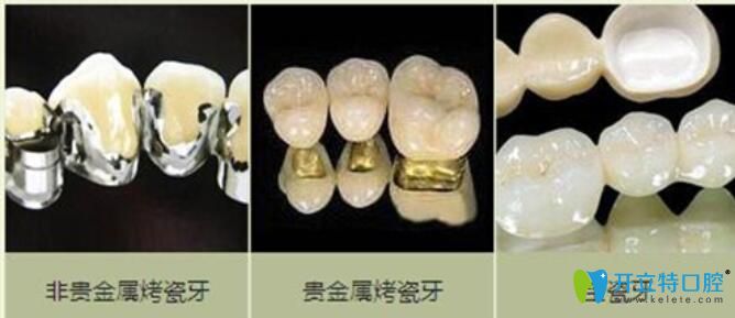 烤瓷牙種類