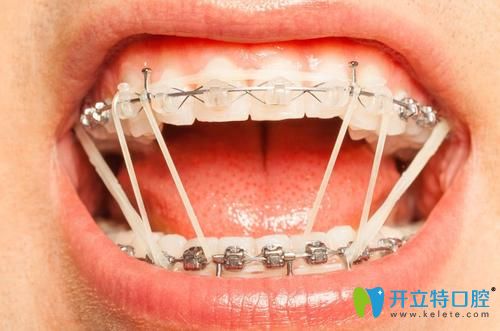 what？有人疑惑正畸橡皮筋吃飯刷牙時還得拿下來么