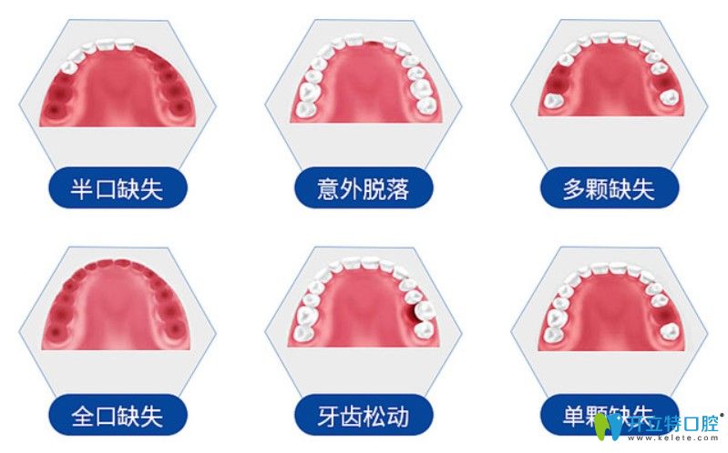 德國賽弗種植體適用于哪些牙齒