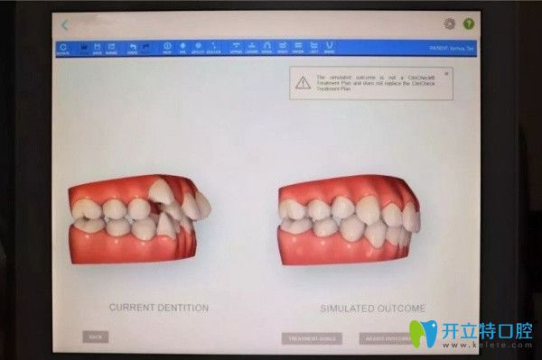 口掃儀可在術前看到矯正效果