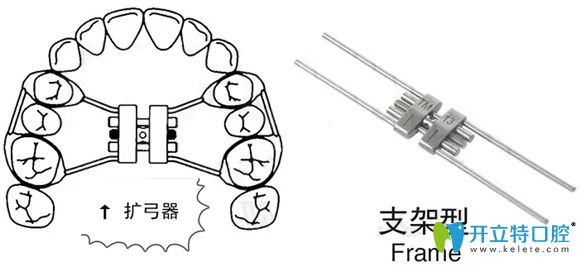 擴(kuò)弓矯正牙齒的那種擴(kuò)弓器一般戴多久呢,剛戴覺得不適應(yīng)