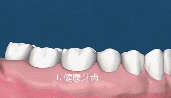 電動(dòng)牙刷可以去除牙結(jié)石嗎？這個(gè)回答比較精準(zhǔn)