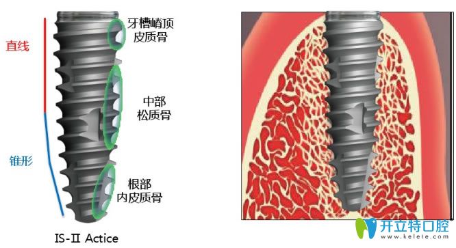 韓國紐百特種植體優(yōu)點(diǎn)