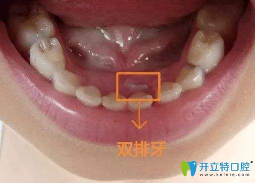 孩子長出雙排牙只因?yàn)槁槁榉噶艘粋€(gè)錯(cuò)誤你敢信？