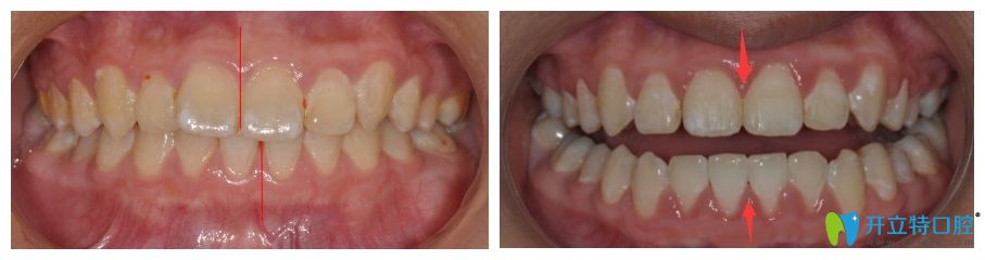 廣大口腔美國Ormco自鎖托槽矯正案例效果圖