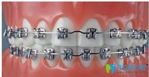 廣大口腔美國Ormco（DamonQ）金屬自鎖托槽正畸