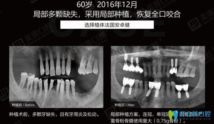局部多顆牙缺失采用局部種植12顆牙齒