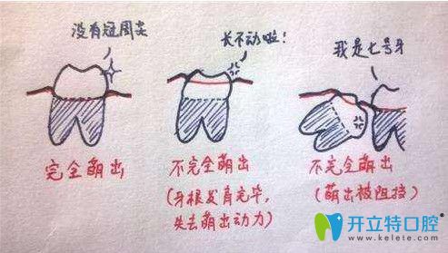 林智偉醫(yī)生講解智齒一般分類(lèi)