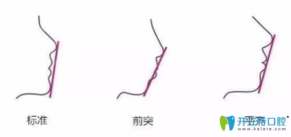 咬合不正常會導致臉型不好看