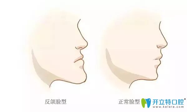 反頜臉型