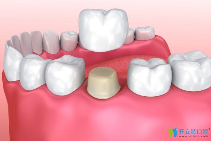 為什么剛戴上全瓷牙吃東西會疼