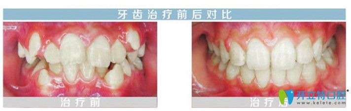 舌側(cè)隱形牙套矯正虎牙前后對(duì)比照