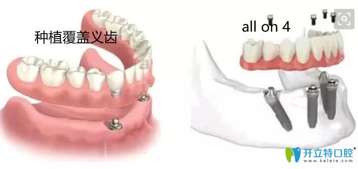 種植覆蓋義齒優(yōu)勢
