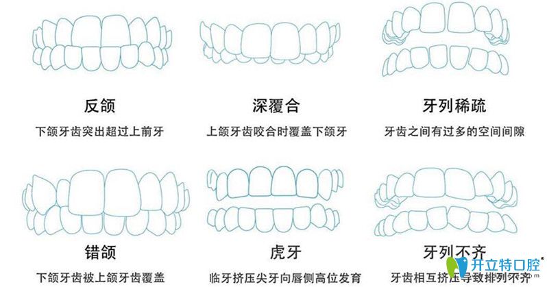 6大牙齒問題需要做矯正