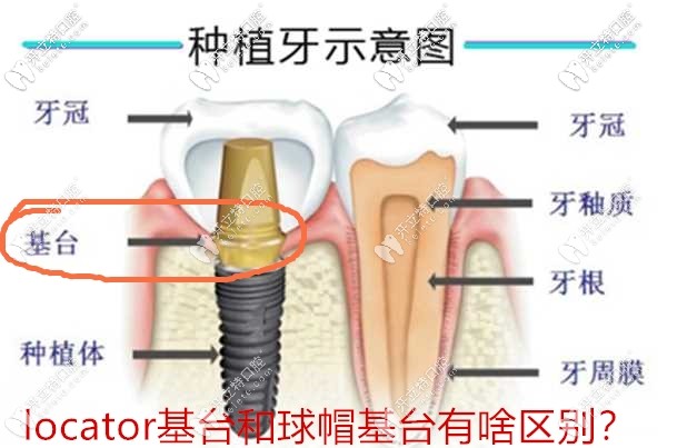種植牙基臺(tái)結(jié)構(gòu)示意圖